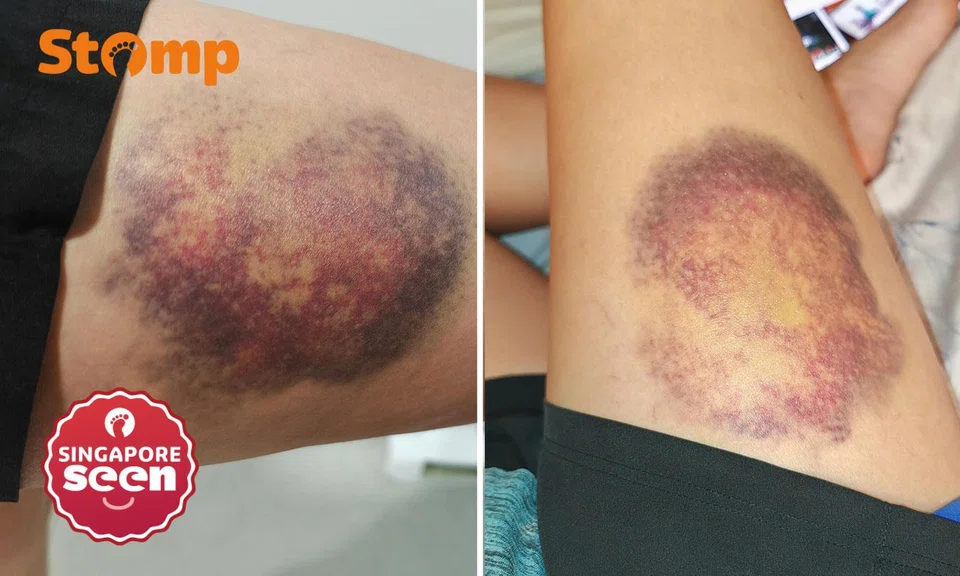 woman suffers large bruise on thigh after Go-Ahead bus suddenly stops