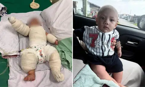 5-month-old baby from sarawak suffers severe burns after hot water and rice from rice cooker spills on him