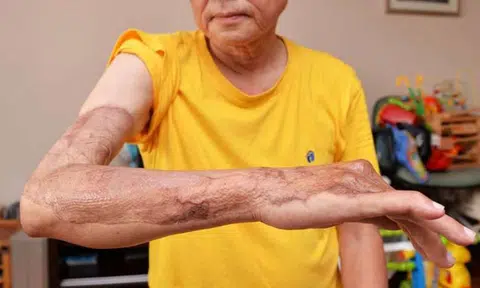 Man, 68, undergoes 7 operations after contracting flesh-eating disease following Taiwan trip
