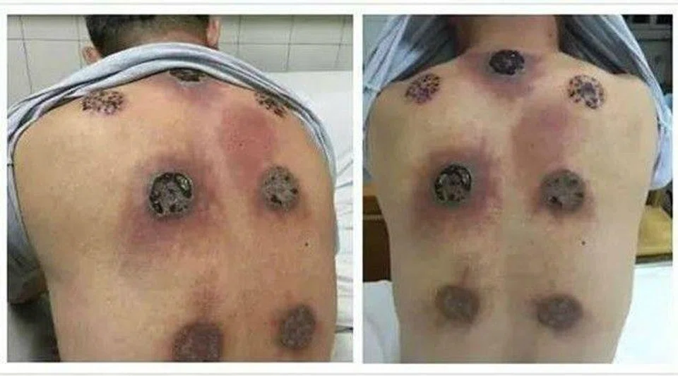 See what happens when you undergo cupping therapy every day for a month