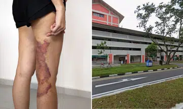 woman’s legs covered in bruises after pai sha treatment