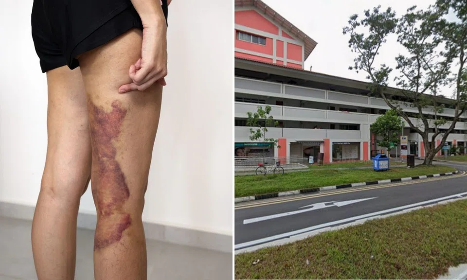woman’s legs covered in bruises after pai sha treatment