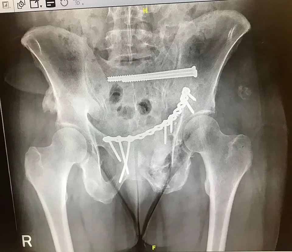 Mr Patrick Pereira suffered an open book fracture on his pelvis after his accident with a lorry along Jurong East Avenue 1 on Sept 10, 2017.