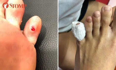 Woman makes police report after skin on her toe gets shaved off during pedicure at Jln Bukit Ho Swee nail salon