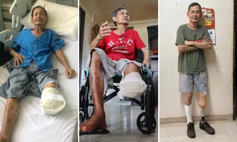 Duan Weiming whose left leg was amputated can now stand and walk, thanks to prosthetic leg