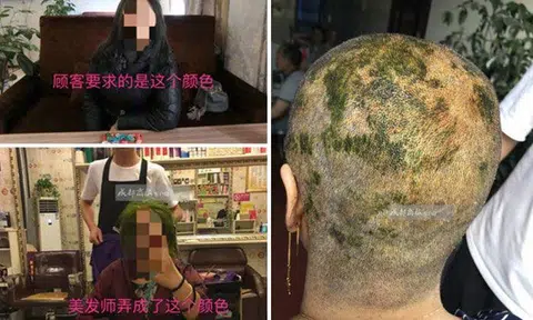 Sichuan woman becomes bald after dyeing her hair 4 times in salon