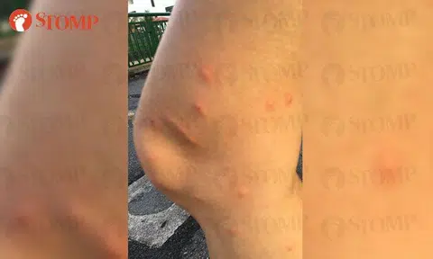 SIA responds to passenger's claim about getting bitten by bed bugs in business class from Brisbane to S'pore