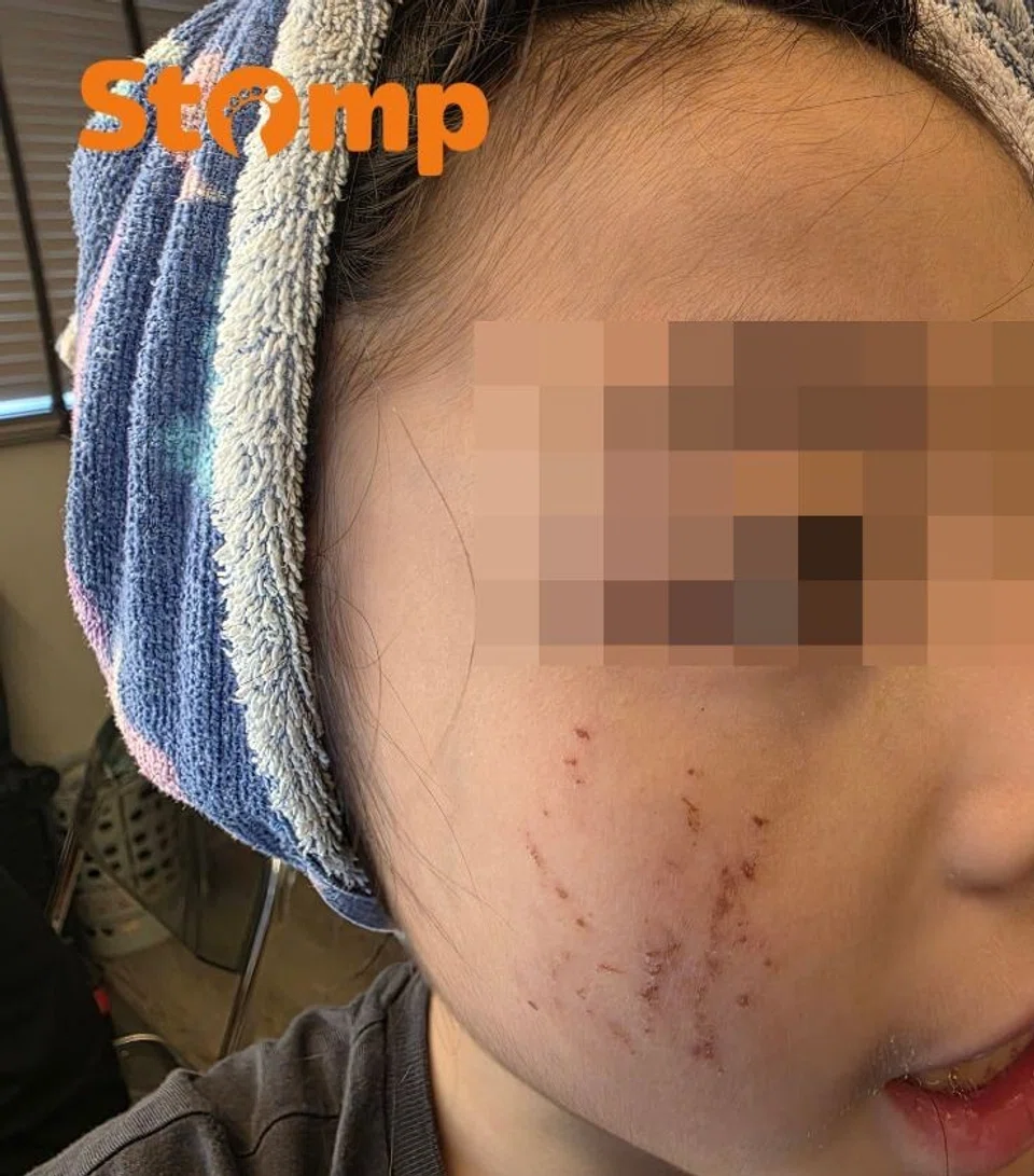 Child, 10, scratches face while removing National Day tattoo, mother claims school did not call her
