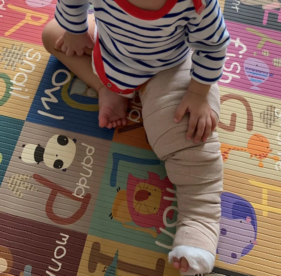 Cassie at 10 months old, with her affected leg in a compression bandage to reduce swelling and pain, which increased when she started crawling. 