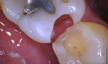 woman JB dentist cavity tooth