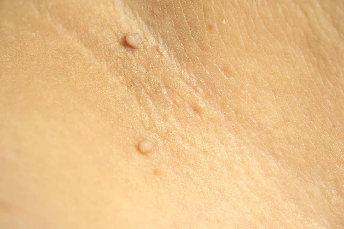 nytskin09 - Pedunculated Mass skin tag or acrochondon or soft fibroma. Papilloma bump on male body macro shot on the Thigh

Credit: ISTOCKPHOTO