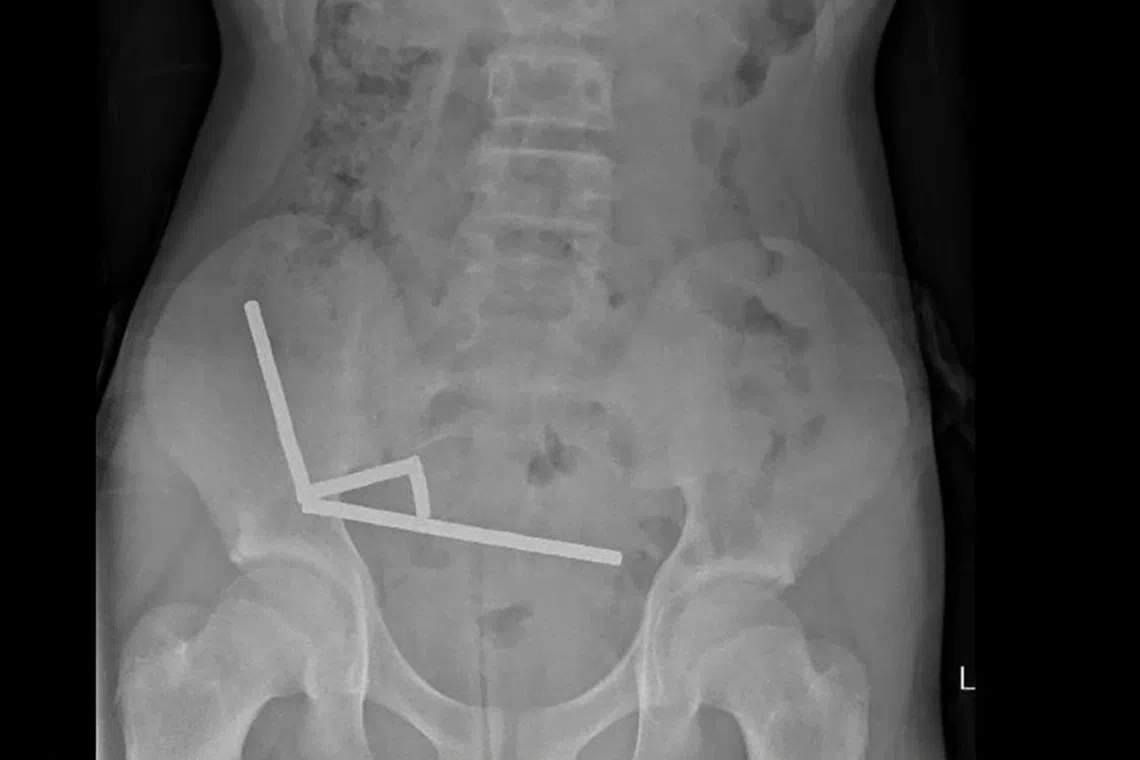 An x-ray image of pieces of high-power magnets clumped up in the intenstines of a New Zealand teenager in Tauranga.