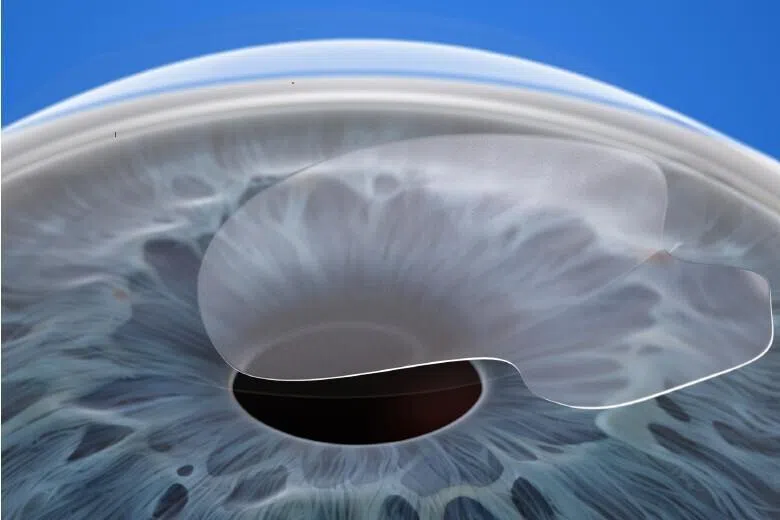 SILK surgery at Dr Natasha Lim Eye Centre