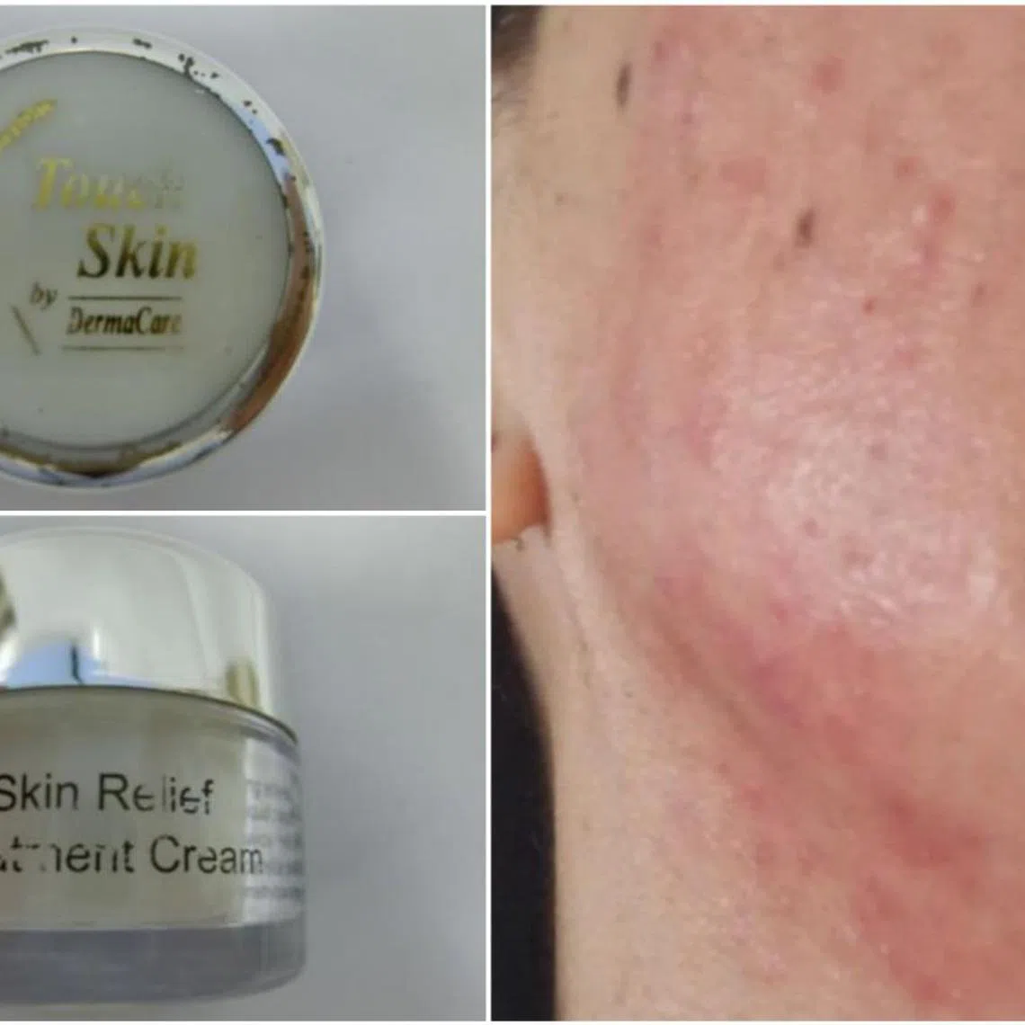 A woman suffered severe skin reactions after using Touch Skin by DermaCare Skin Relief Treatment Cream.