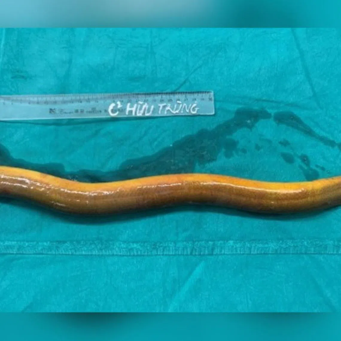 The doctors discovered a live eel approximately 65cm long and 10cm in circumference in the patient’s abdominal cavity.