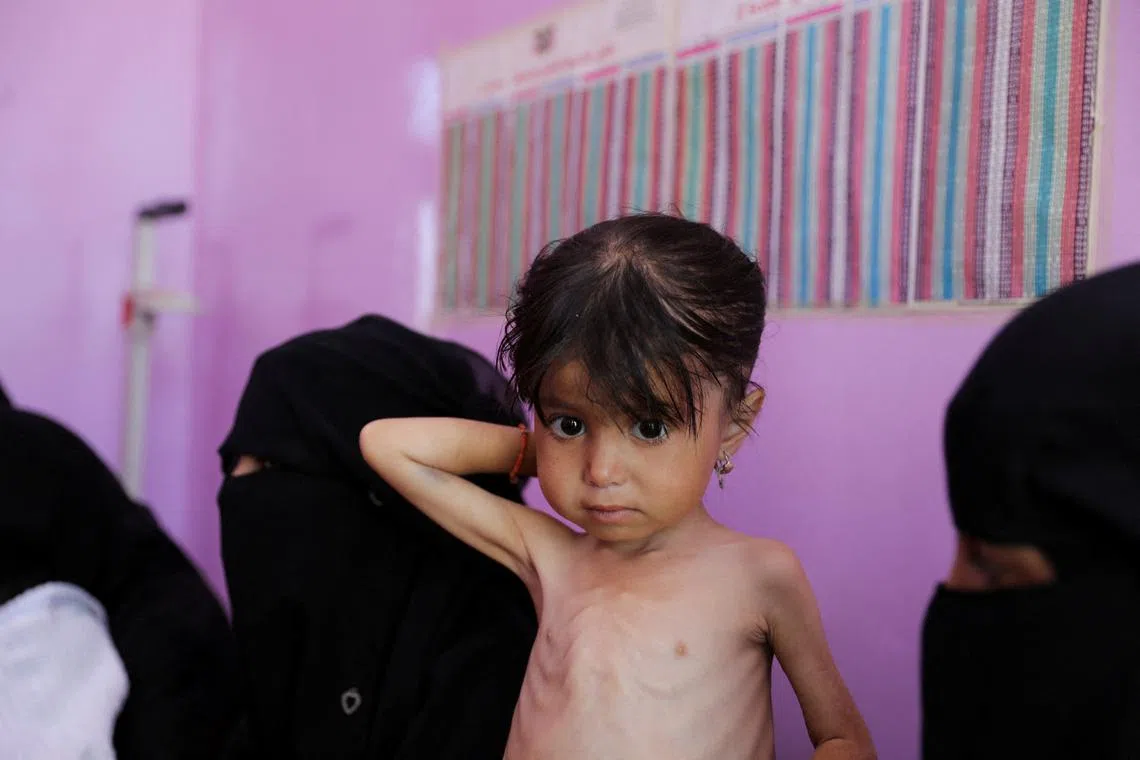 FILE PHOTO: A malnourished girl waits at a measurement room of a hospital as Yemeni children face the risk of medical complications amid high levels of food insecurity, in Sanaa, Yemen March 2, 2024. REUTERS/Khaled Abdullah/File Photo