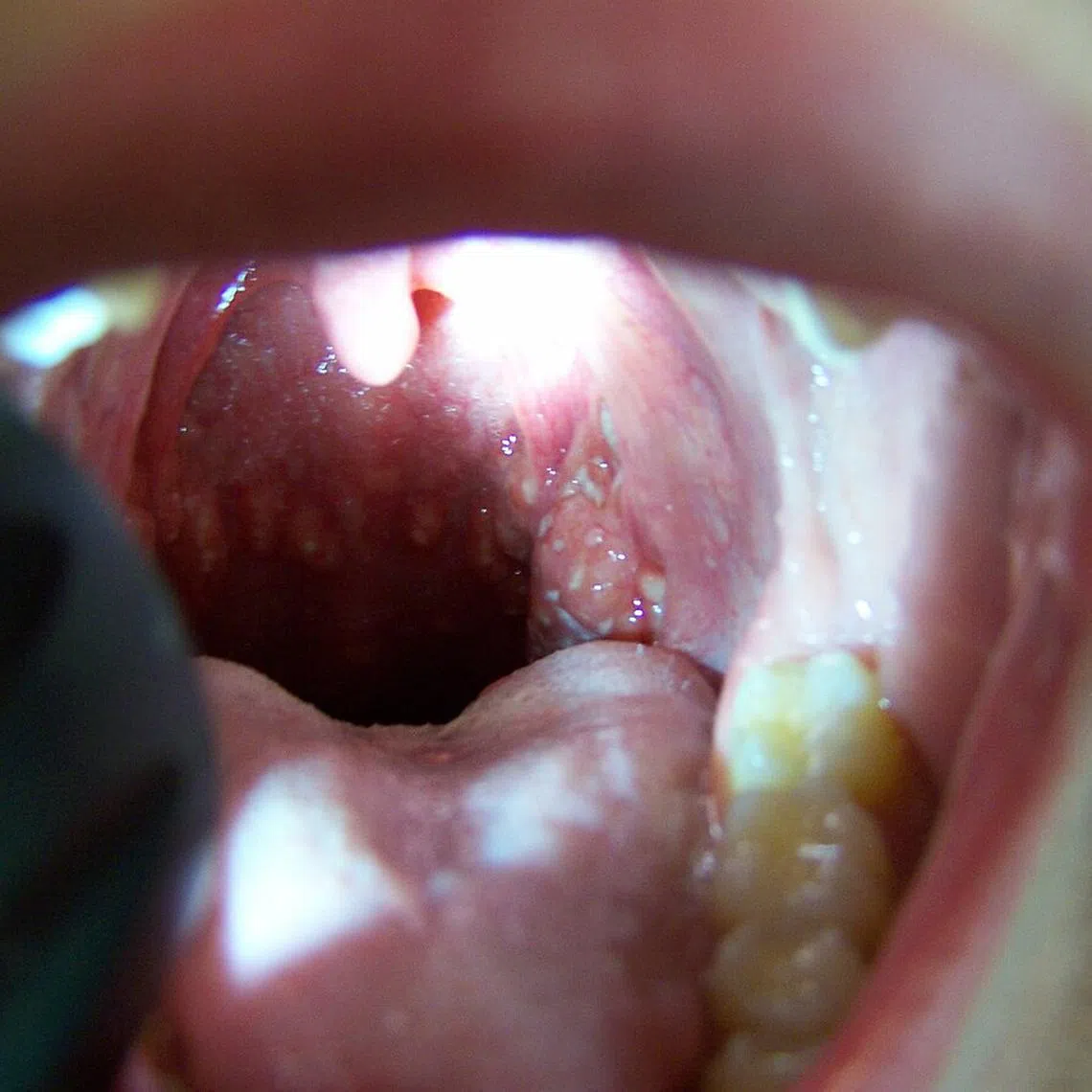Herpangina is an infectious condition where one develops blisters and ulcers in the mouth.