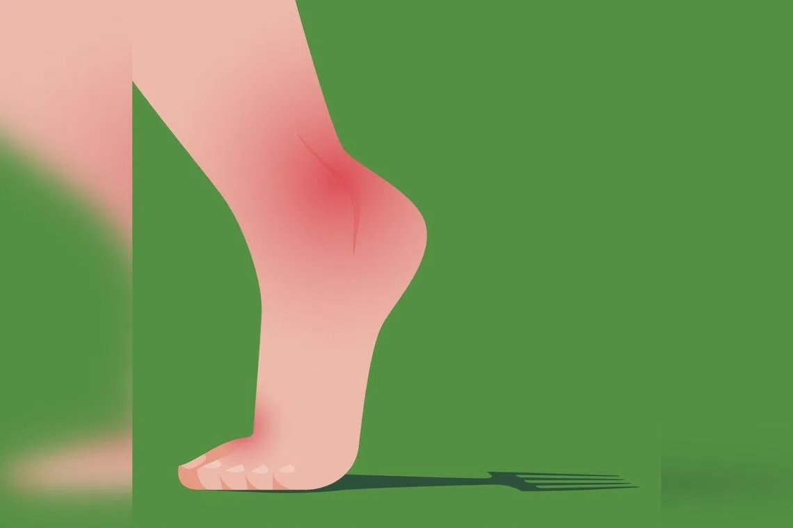 Gout is an increasingly common condition, but stigma often prevents sufferers from obtaining treatment. 