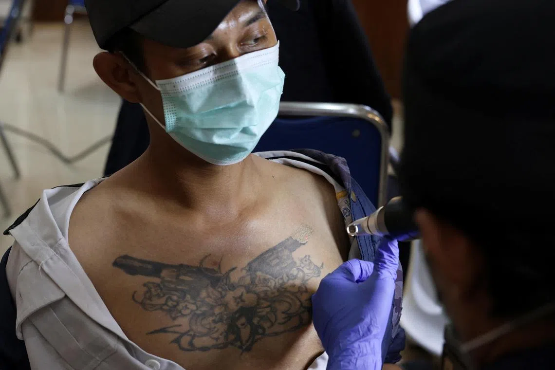 A man gets his tattoo removed with a laser during the event held by an Islamic charity organisation.  