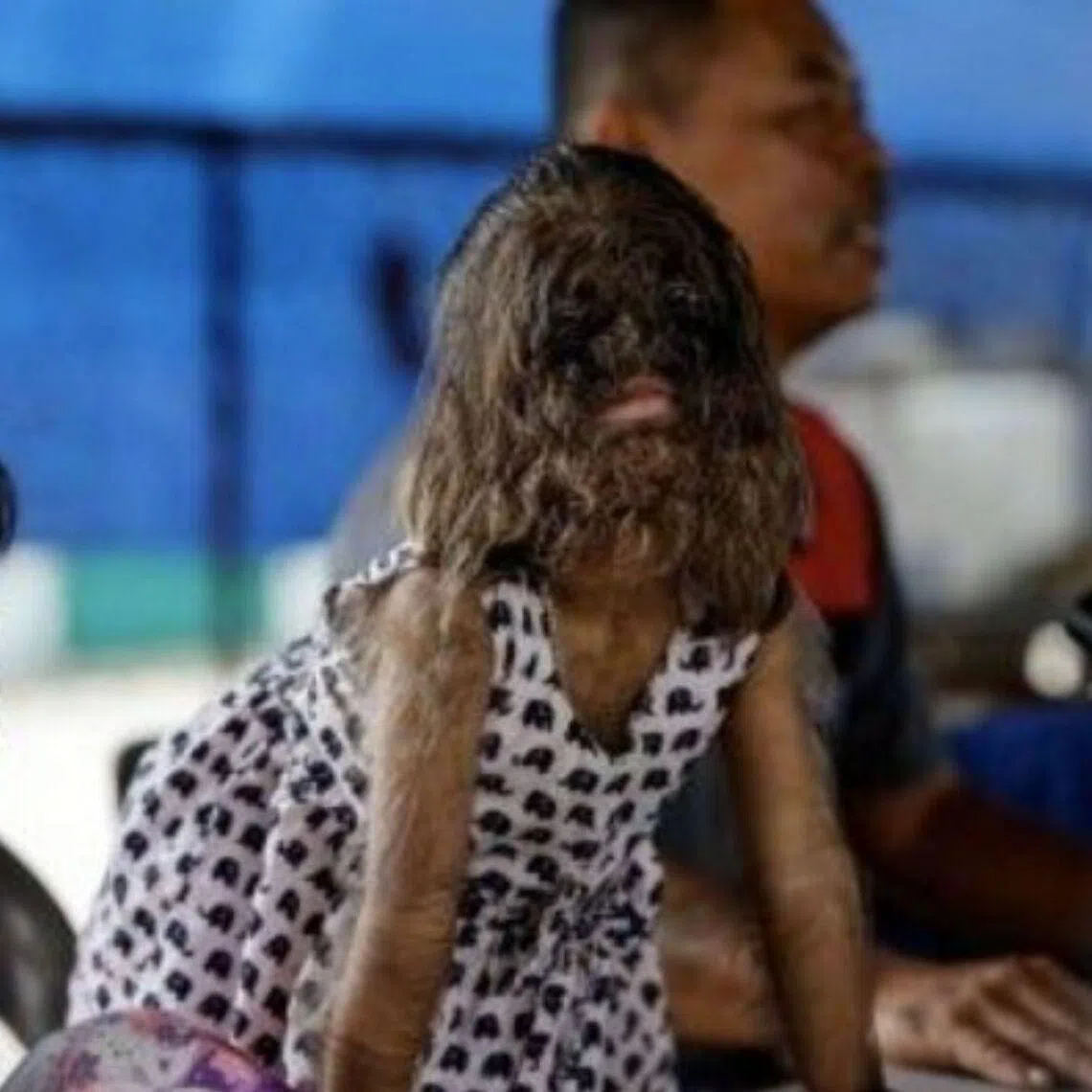 Medically known as hypertrichosis, werewolf syndrome is an extremely rare condition characterised by excessive hair growth.