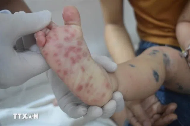 Nearly 7,300 cases have been reported in Ho Chi Minh City since the beginning of the year.