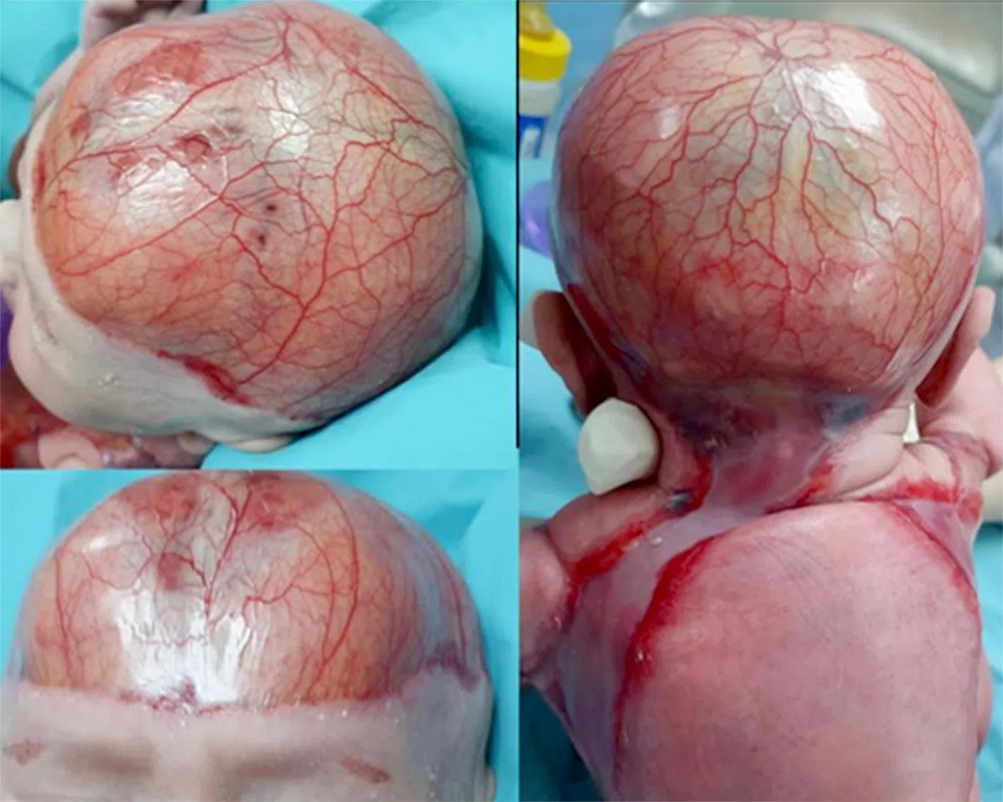Singapore General Hospital neonatologist Alvin Ngeow said Sumayyah’s issue was that the skin on her head was replaced by a thin membrane that was so transparent that her brain was visible, “and that was worrying”.