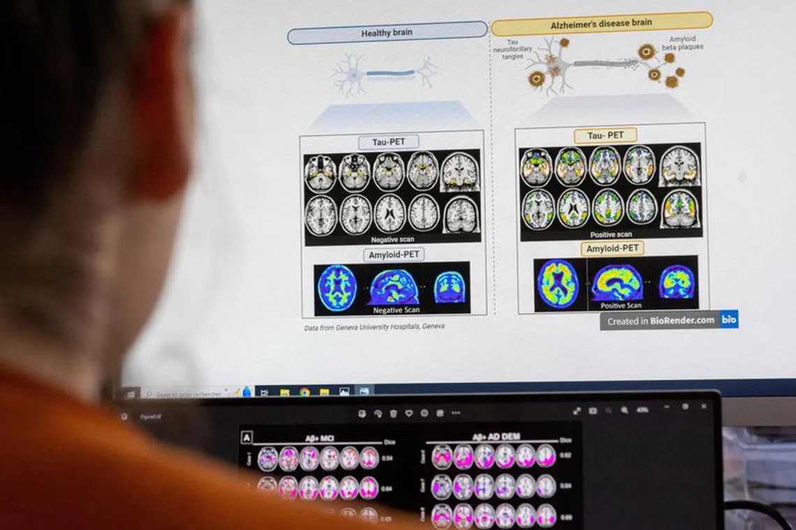 FILE PHOTO: A scientist looks at scans of brains at the Memory Centre at the Department of Readaptation and Geriatrics of the University Hospital (HUG) in Geneva, Switzerland, June 6, 2023.  REUTERS/Denis Balibouse/File Photo