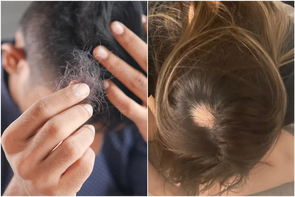 Cough, brain fog and now hair loss? Here is another symptom of long Covid that you may not know about.