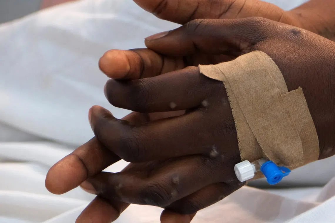 FILE PHOTO: The hands of a patient with skin rashes caused by the mpox virus are pictured in Kinshasa, Democratic Republic of Congo August 30, 2024. REUTERS/Justin Makangara/File Photo