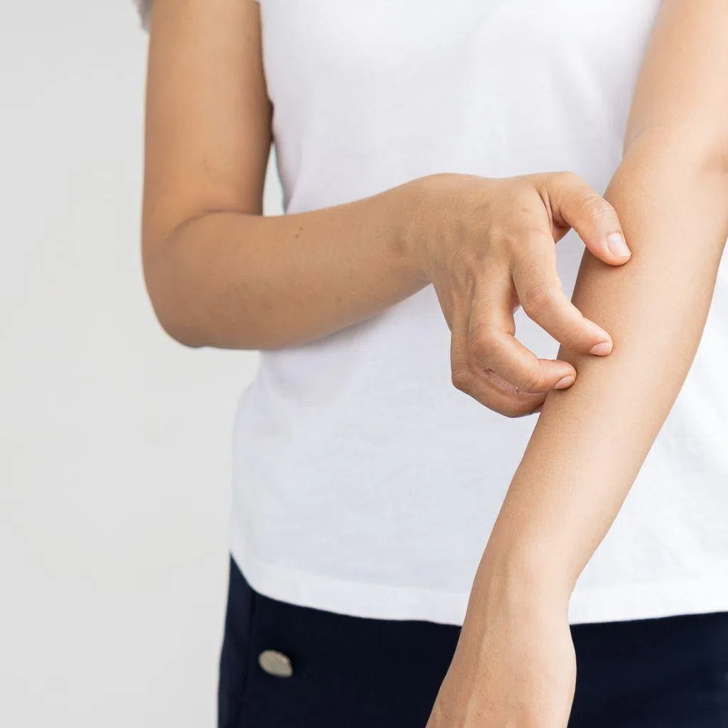 Chronic spontaneous urticaria, or CSU, causes intense, recurring itching and raised hives that can appear without warning and with no identifiable trigger.