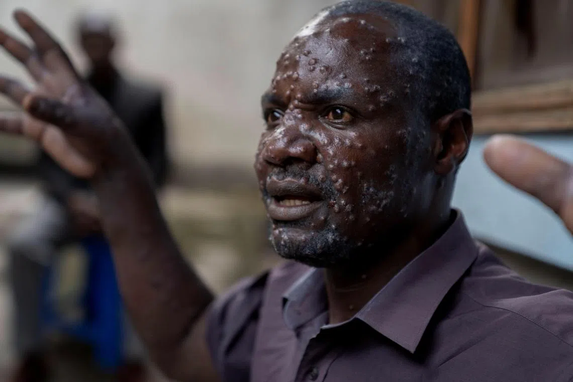 Father-of-six Jean Kakuru Biyambo, 48, being treated for mpox in the Democratic Republic of the Congo, on July 16.