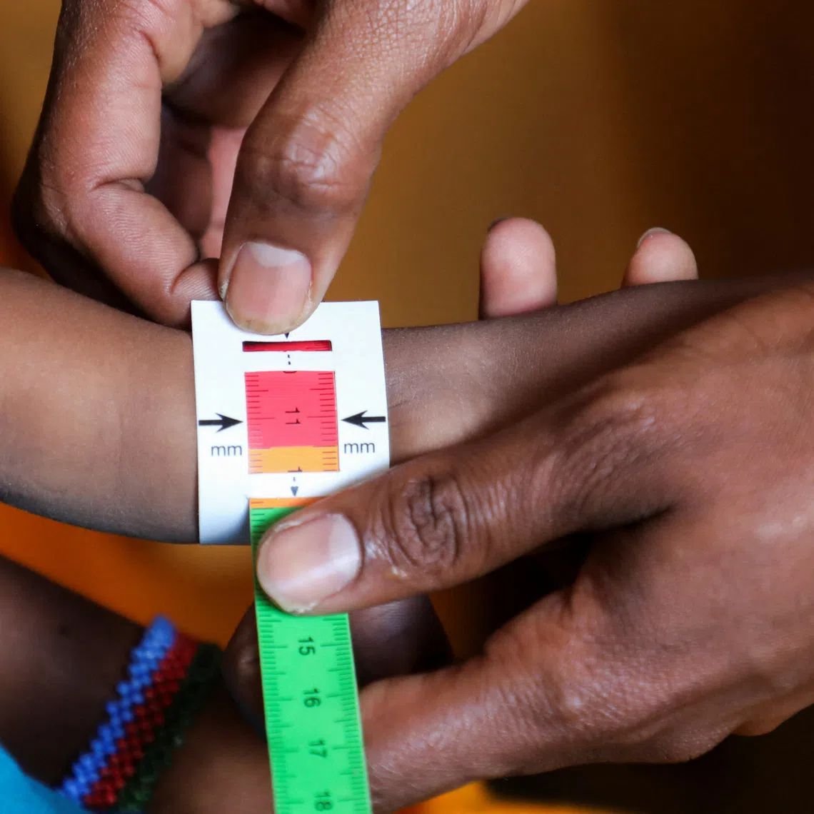 FILE PHOTO: A Somali medical worker screens an internally displaced child for malnutrition at the Medecins Sans Frontieres (MSF) health centre at the Elbet 1 camp as humanitarian funding continues to decline despite rapidly increasing needs according to Medecins Sans Frontieres (MSF), in Baidoa, Somalia  August 10, 2026. REUTERS/Feisal Omar/ File Photo