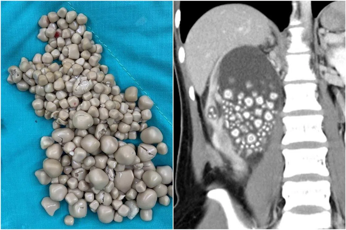 More than 300 kidney stones that looked like “small steamed buns” were removed through minimally invasive surgery.