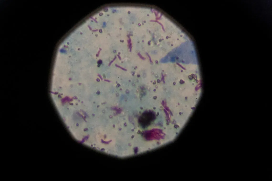 FILE PHOTO: A sample that tested positive for tuberculosis is seen from a microscope in Buenos Aires, Argentina, March 29, 2019. REUTERS/Magali Druscovich/File Photo