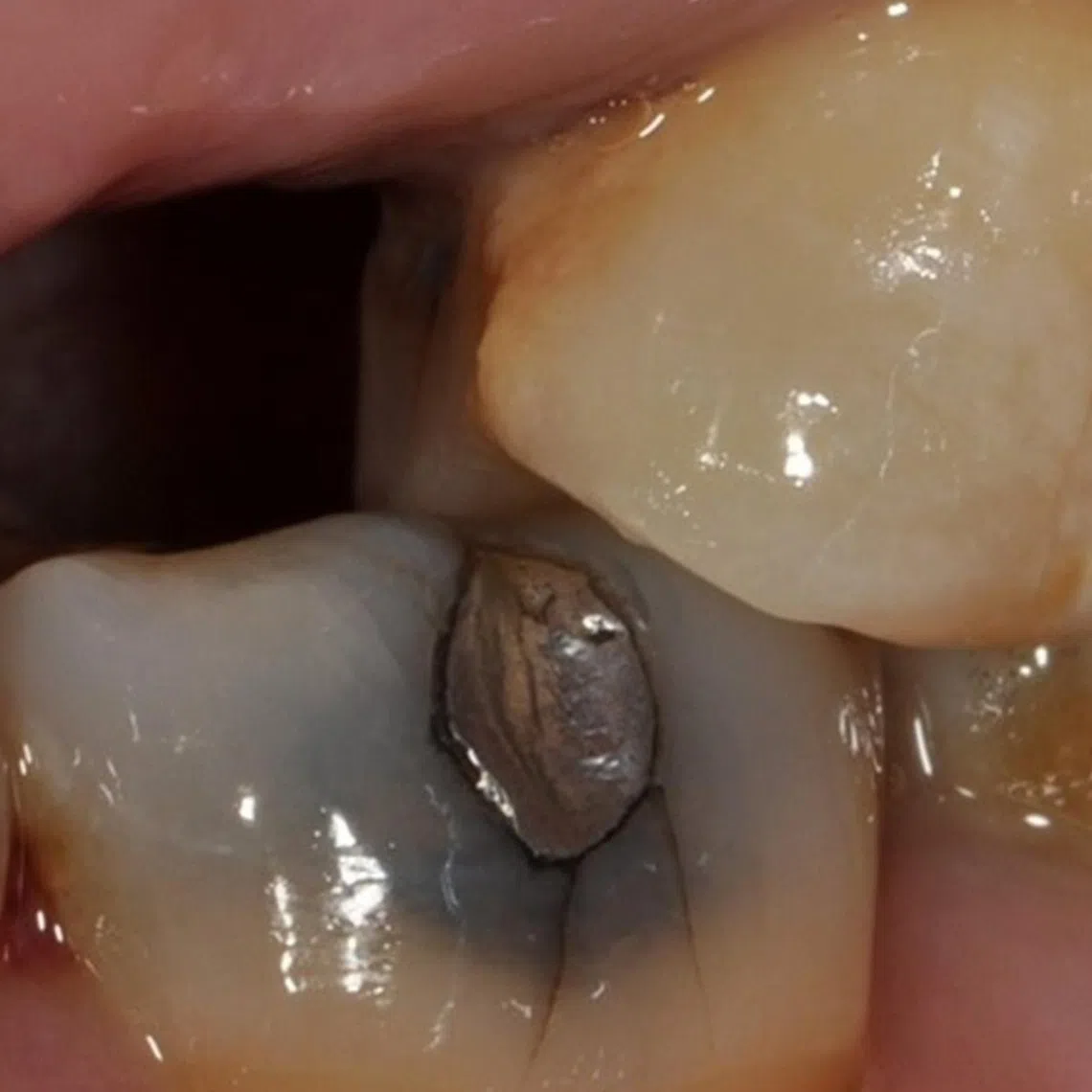 The photo shows a tooth with a mercury filling.