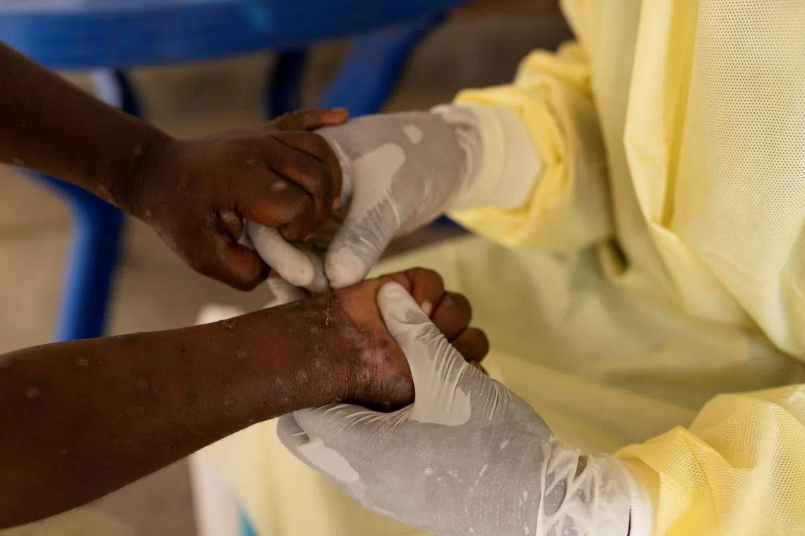 A nurse in the Democratic Republic of Congo takes a sample from a child with a suspected case of mpox.