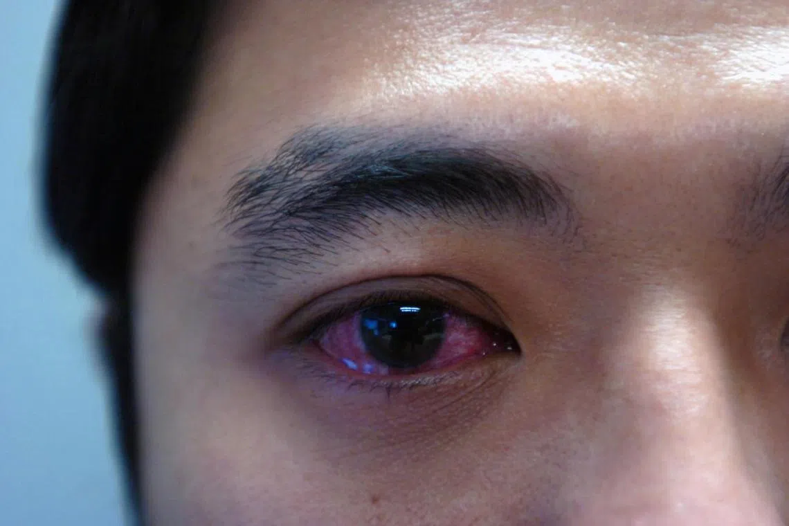 Conjunctivitis is a viral or bacterial infection, with patients experiencing redness and itchiness in the affected eye.