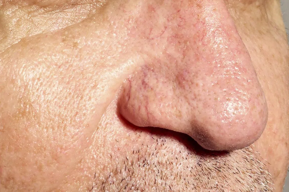 A man with telangiectasias, or “spider veins”, on his nose. Telangiectasias are small dilated blood vessels that have become damaged and are visible just under the skin’s surface. 