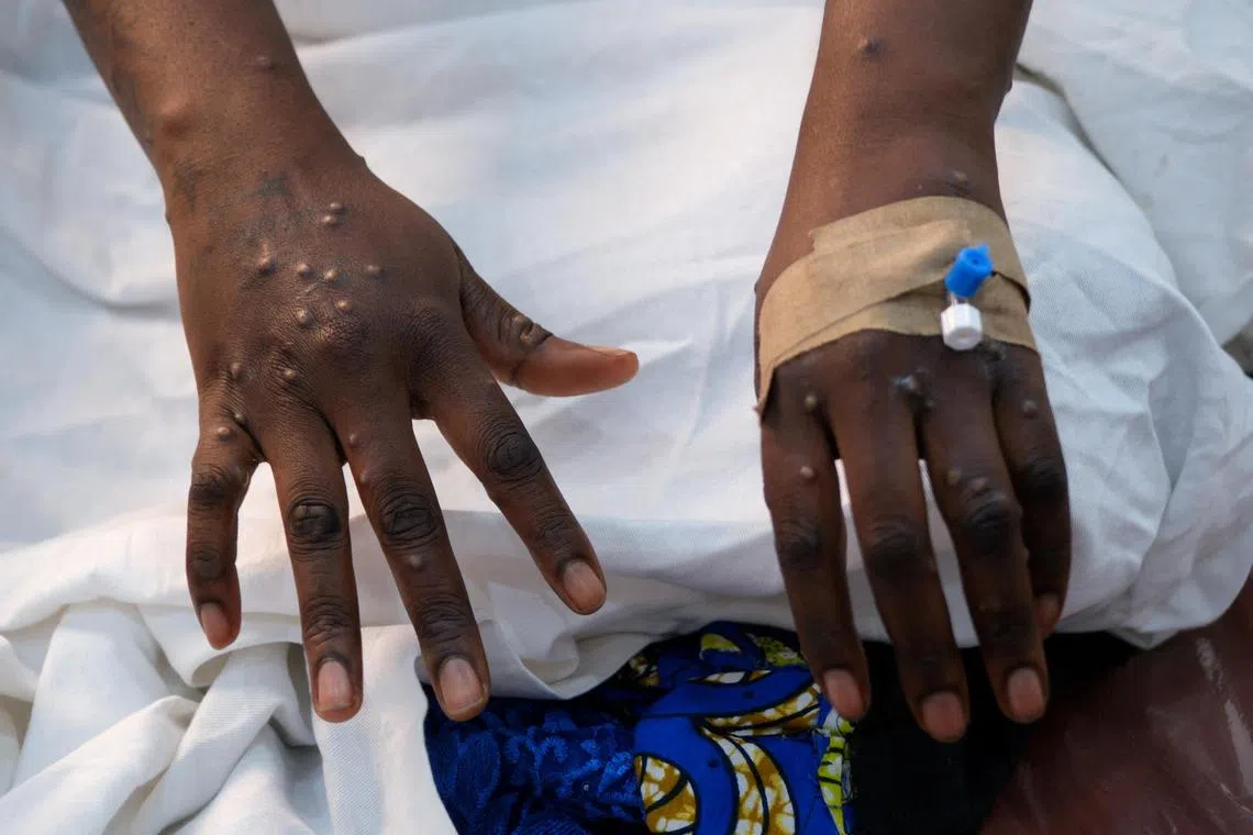 Mpox has spread from its epicentre in the Democratic Republic of Congo to 13 other African nations in 2024.