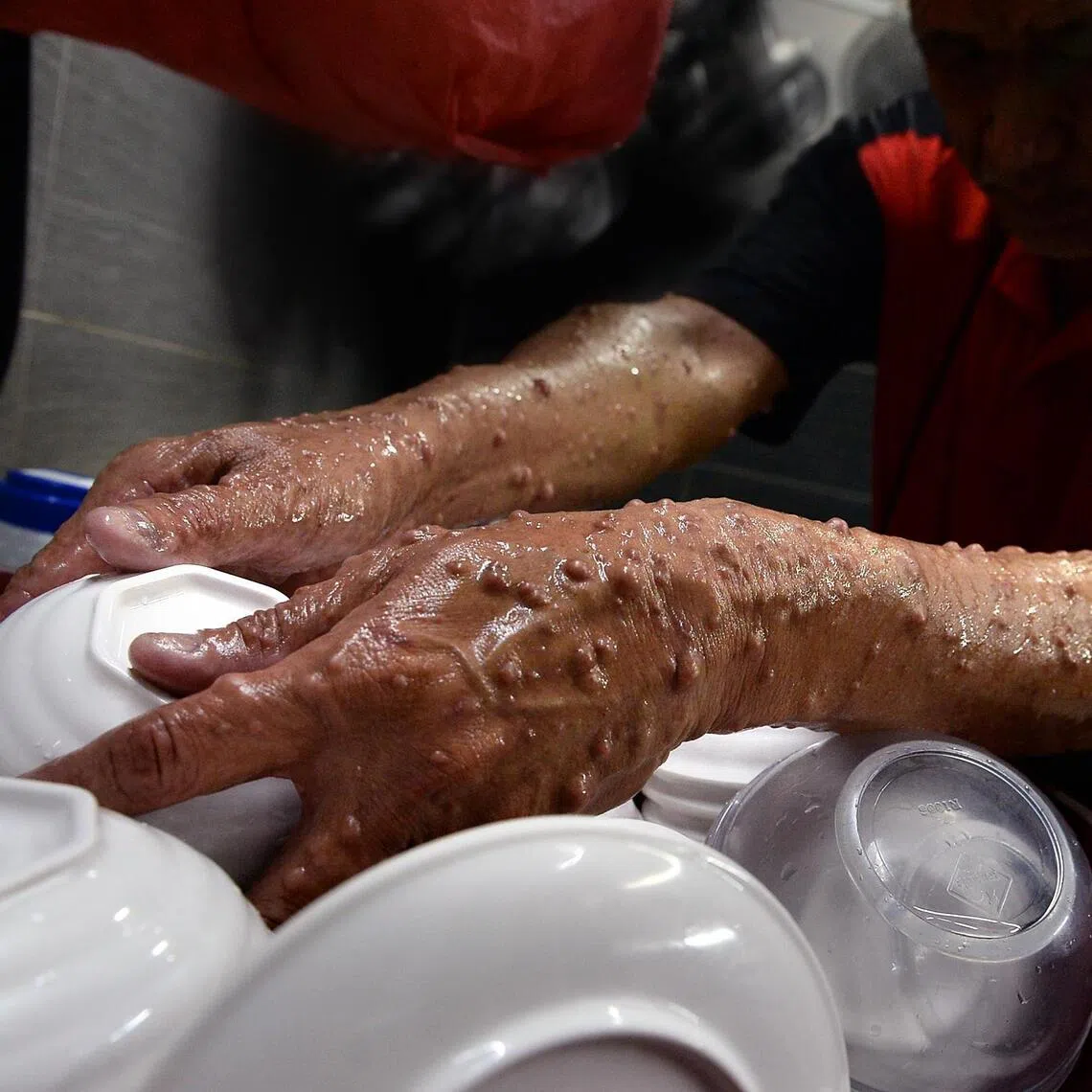 Neurofibromatosis sometimes manifests itself as growth of thousands of benign tumours on the body and face, causing stigma and misunderstandings.