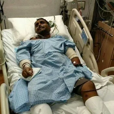 Mr Patrick Pereira had to undergo a nerve graft to repair a contused nerve in his left arm after a lorry collided into him along Jurong East Avenue 1 in 2017.