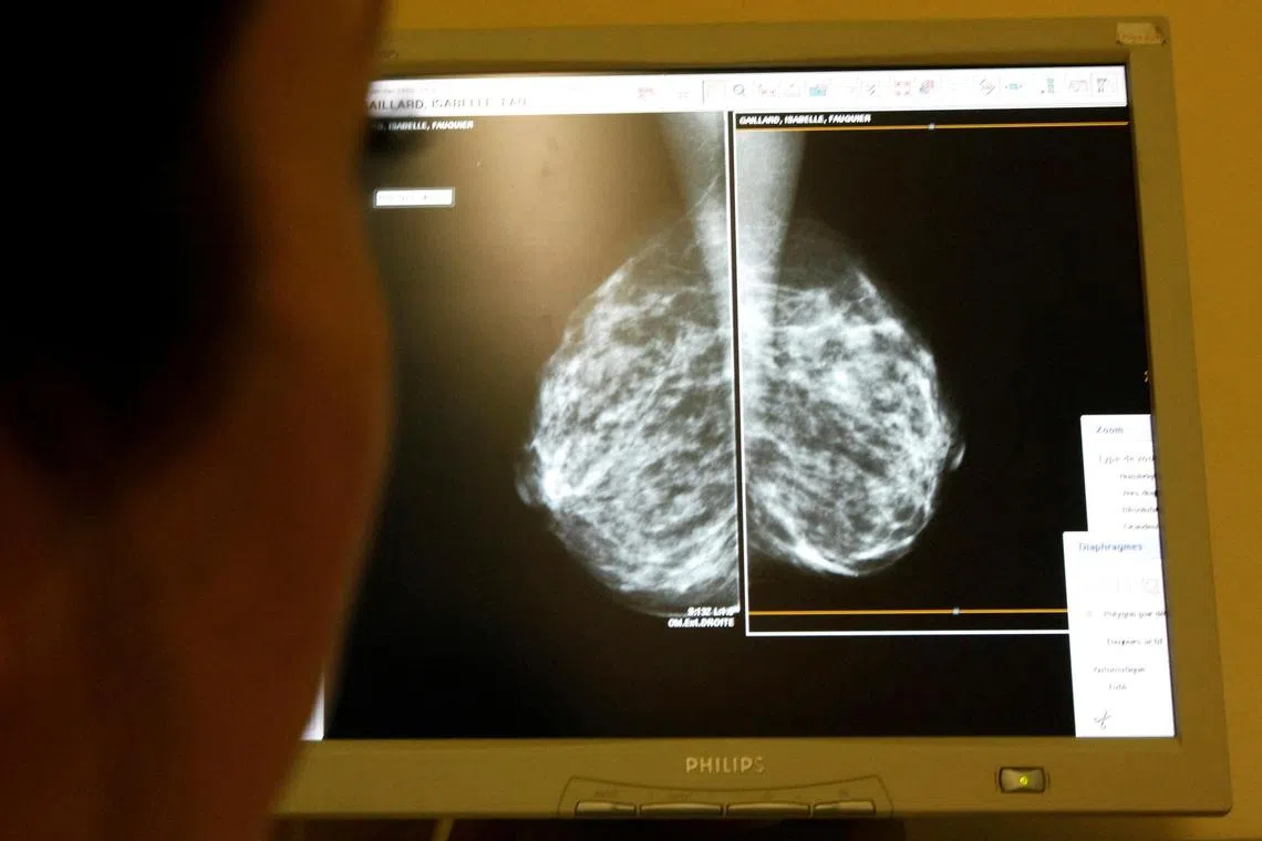 The new rules will help to better advise patients on the potential need for further evaluation or a repeat mammogram