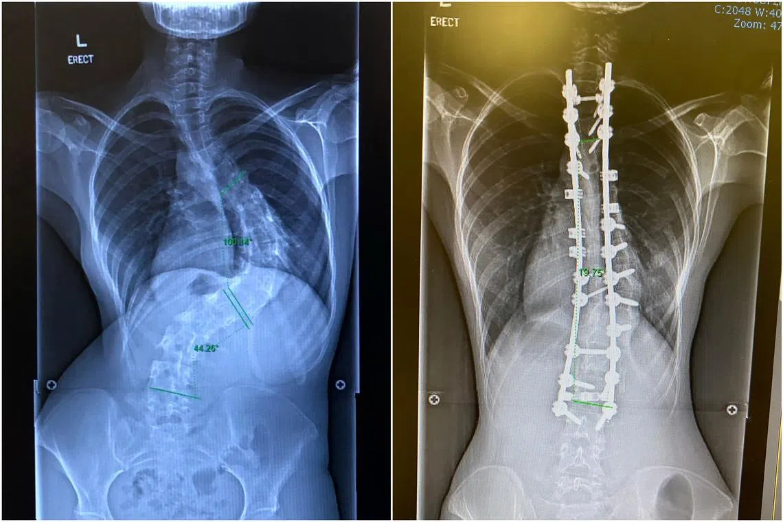 Community relations manager Natasha Ramli, 25, is among those who had to undergo spinal surgery for the condition.