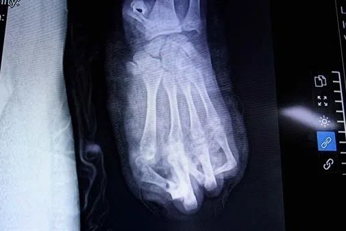 Teen in Vietnam loses most of left hand in improvised firework explosion