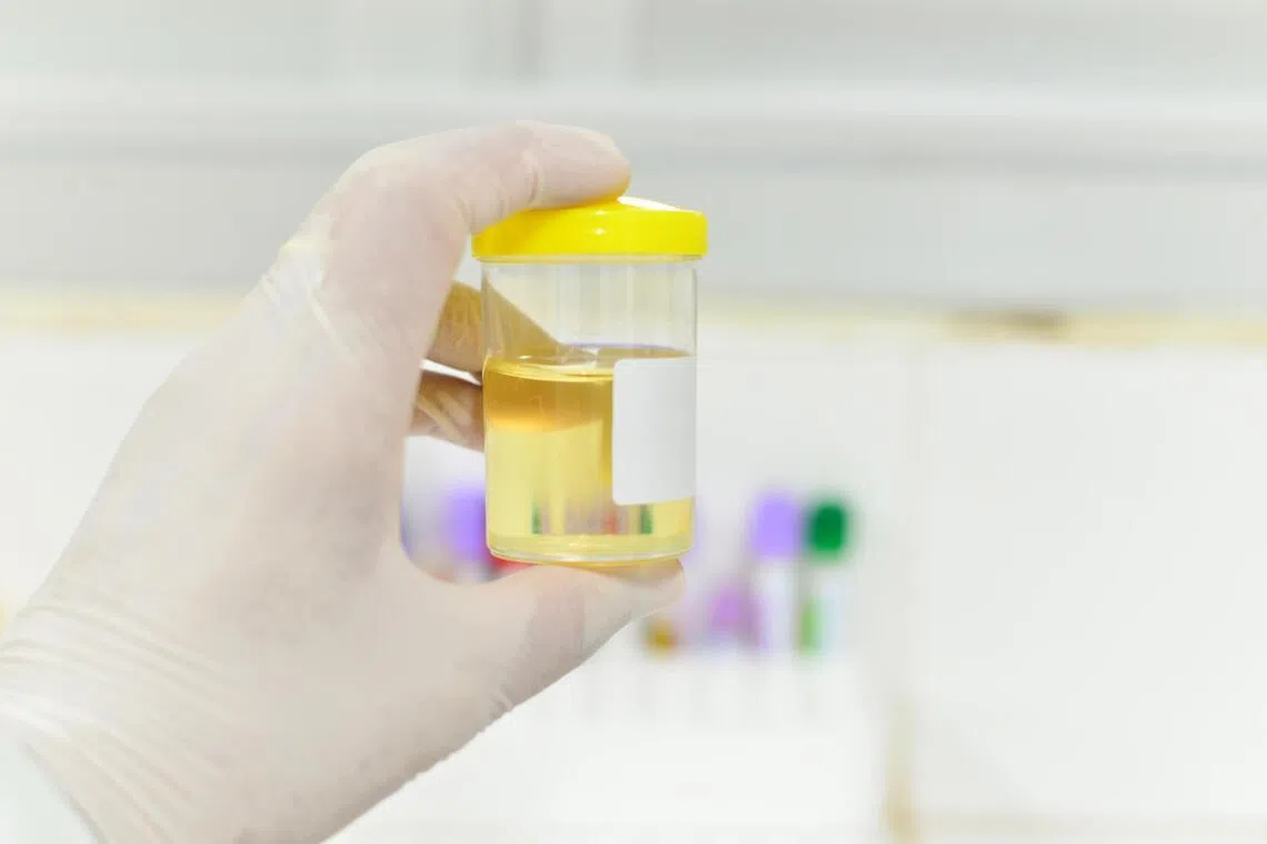 Urine liquid biopsy improves detection of bladder, kidney and prostate cancer