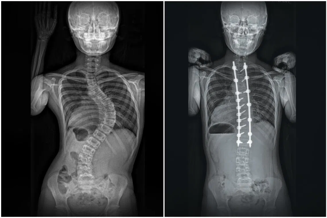 Jayna Leong underwent spinal fusion using special rods, hooks, screws and bone graft to carefully straighten the curved portion of her spine.