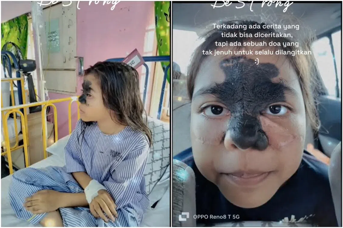 The girl said that although she feels sad and embarrassed by the teasing, she is not angry because her birthmark makes her “different and unique”.