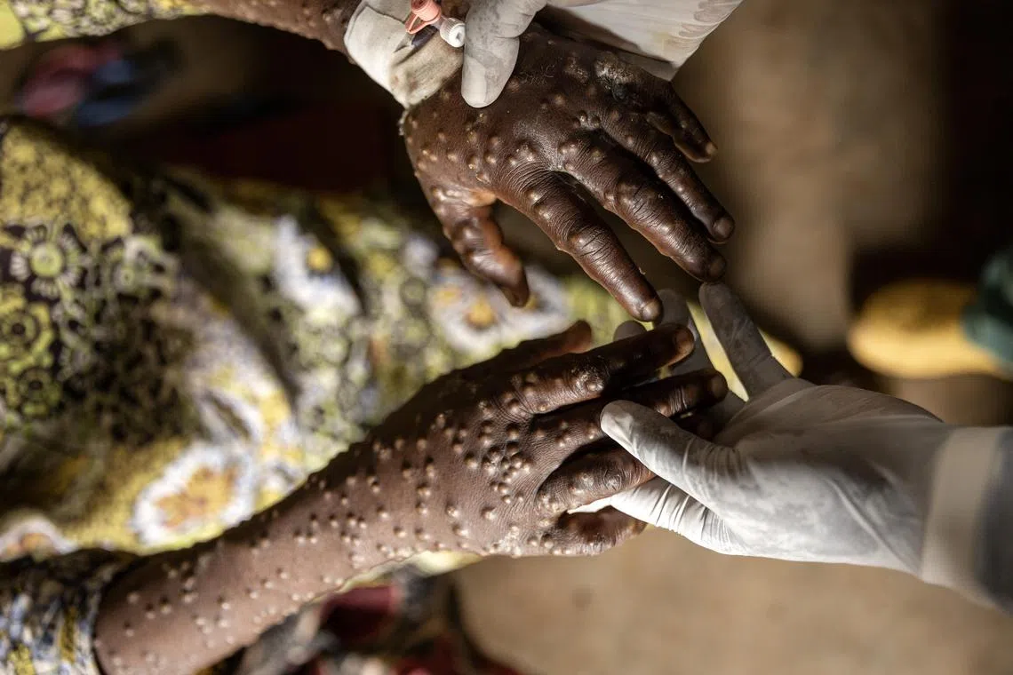 An mpox patient is treated at the Kavumu hospital in Karanrhada, Kamavu, South Kivu province, Democratic Republic of Congo, in September 2024.