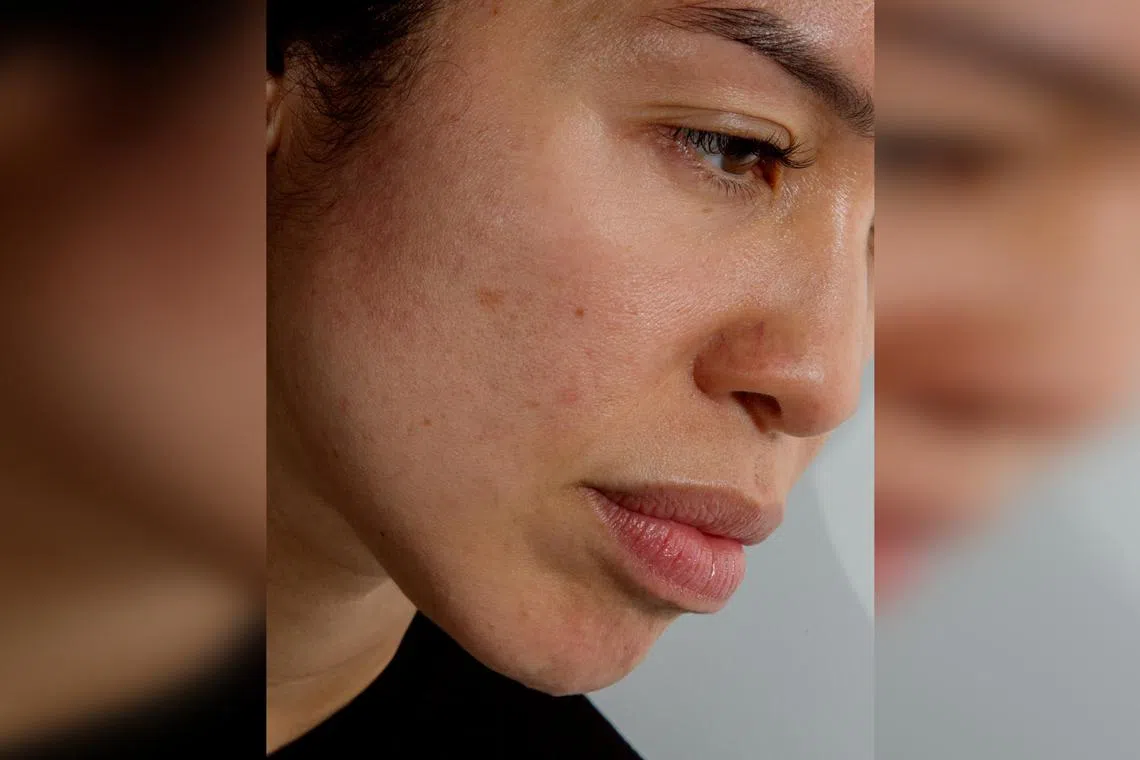 Scientists are not entirely sure what causes rosacea or why it intensifies as you get older, but they have some theories.