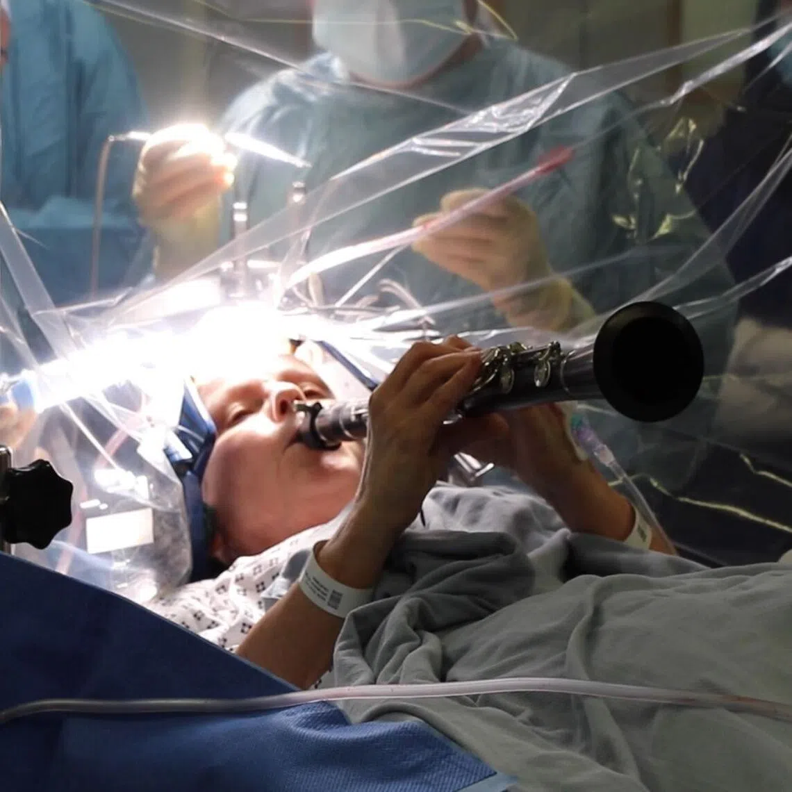 Ms Denise Bacon blew on her instrument as doctors tinkered with her brain through 18mm holes drilled through her skull.